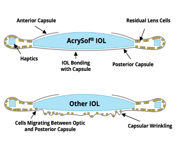 Acrysoft lęšiai geriau prisitaiko prie akies