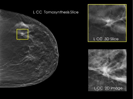 mografija su tomosinteze - aiškesnis krūties audinių vaizdas